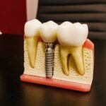 dental_implants_Burlington