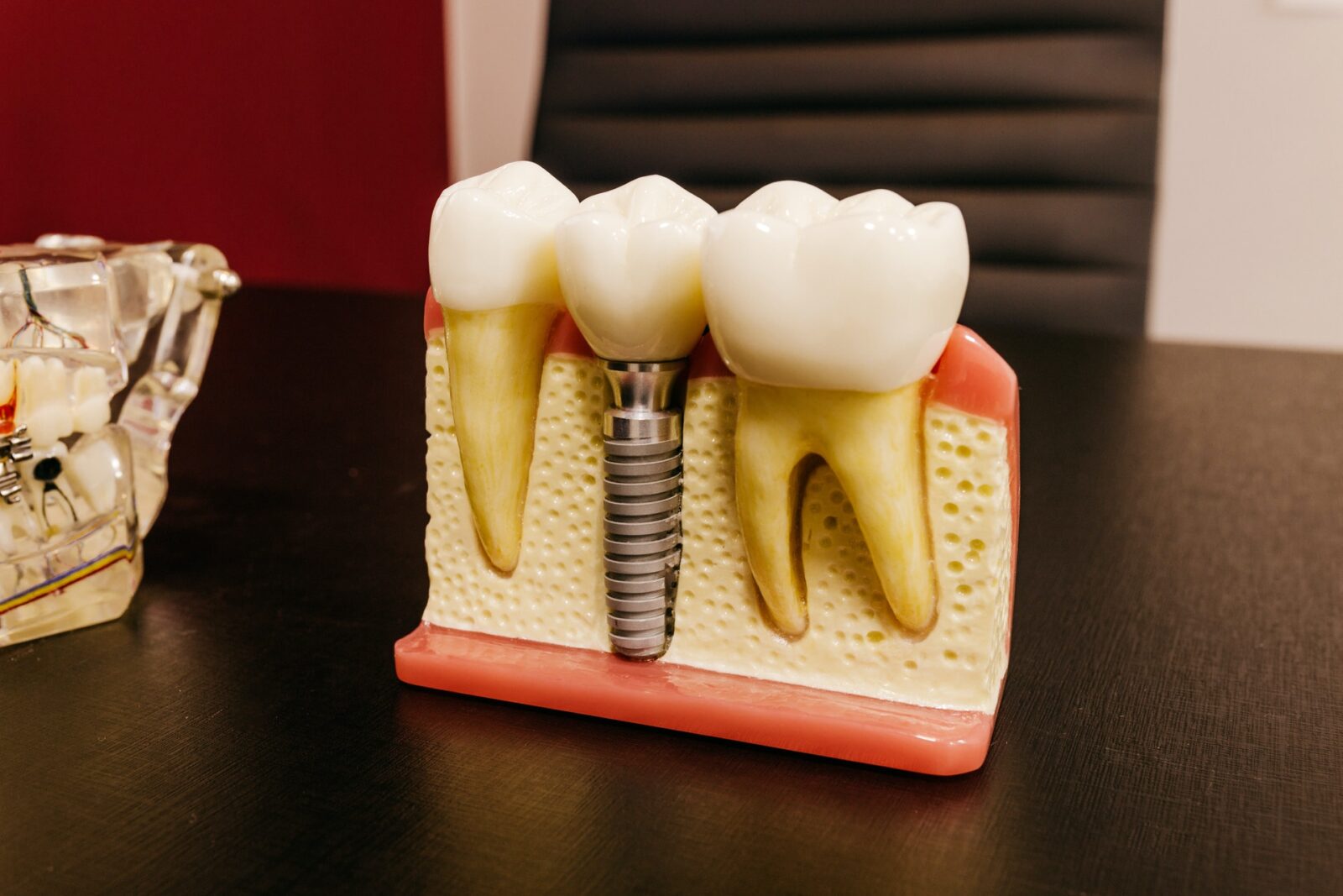 dental_implants_Burlington